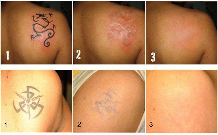 laser tattoo removal step by step