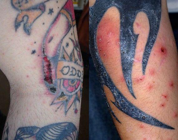 Por que é perigosa unha tatuaxe?