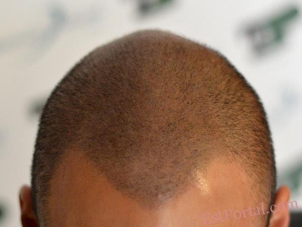 Trikopigmentasyon etkisi yoğunluğu, uzun saçlar için kamuflaj
