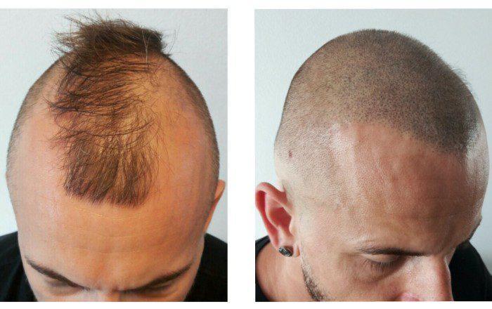 Tricopigmentació, tatuatge semipermanent per a la caiguda del cabell