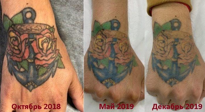 Lasertattoo verwijderen: de resultaten samenvatten met de tattoo-artiest