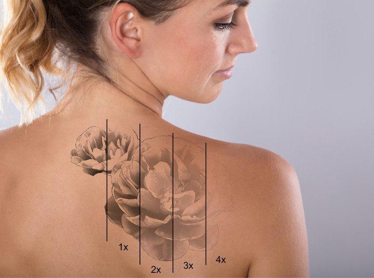 Sve što trebate znati o uklanjanju tetovaža