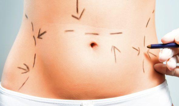 Abdominoplasty: medical care in the field of abdominal surgery