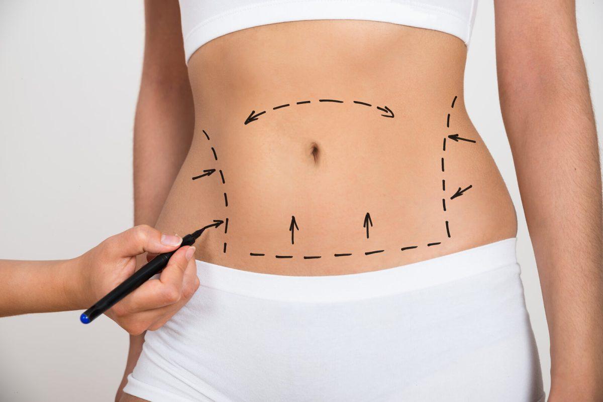 Abdominoplasty: Alles wat jo witte moatte oer tummy tuck sjirurgy