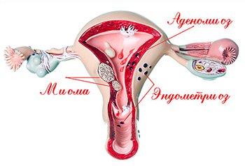 Poen yn yr abdomen ar ôl cyfathrach rywiol - endometriosis, ffibroidau, codennau