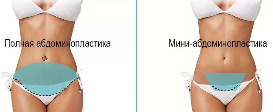 Что такое миниабдоминопластика?