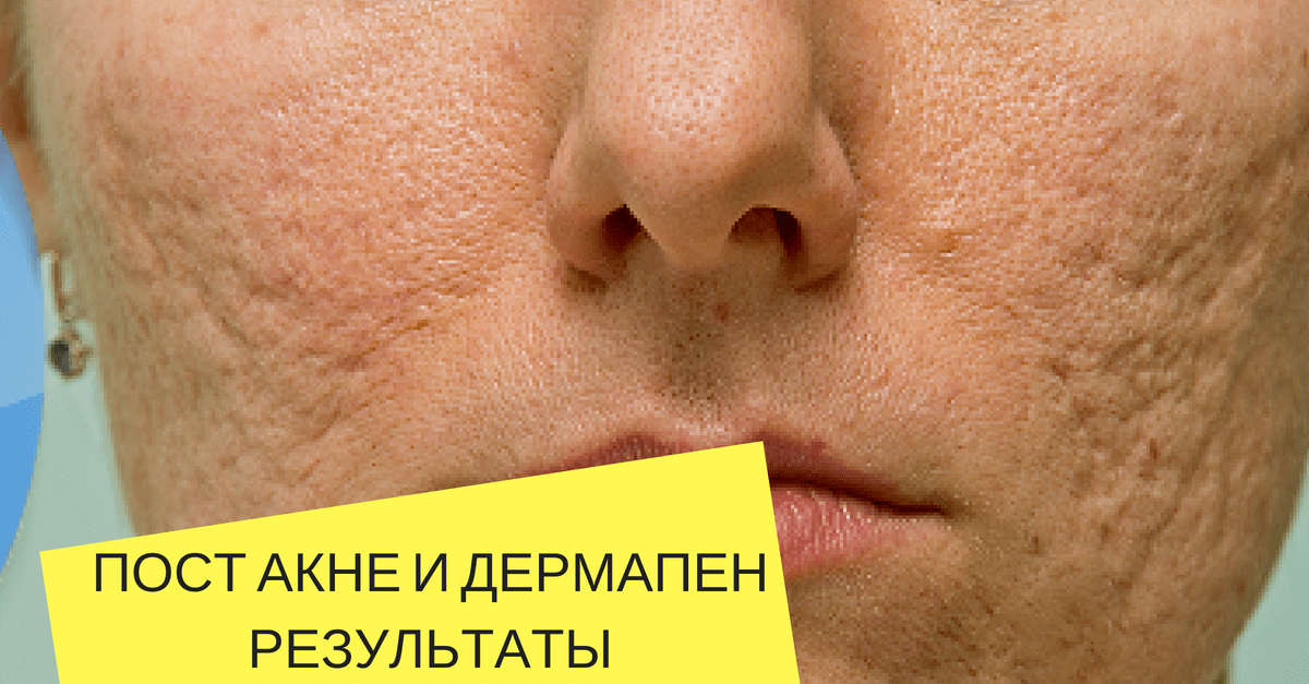 Мезотерапия шрамы. Мезотерапия акне Дермапен. Фракционная мезотерапия лица дермапеном.