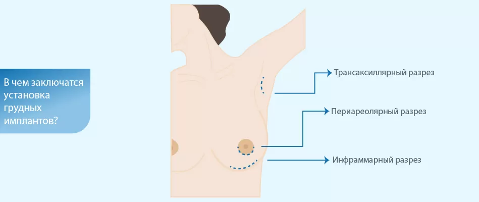 хирургия грудных имплантатов: грудные имплантаты для мужчин цена
