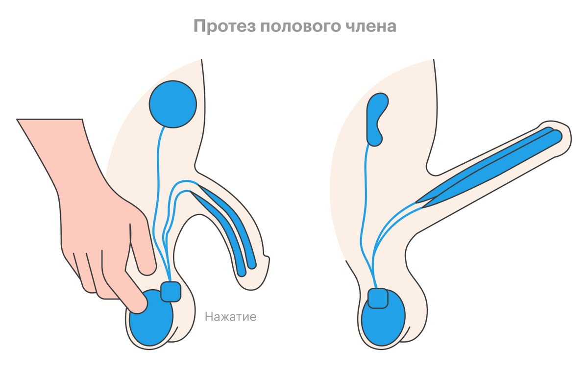 член не встает как вылечить фото 11