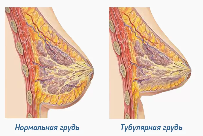 Как распознать и лечить тубулярную грудь?