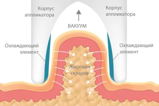 Криолиполиз &#8212; узнайте об инновационном методе замораживания жировых клеток