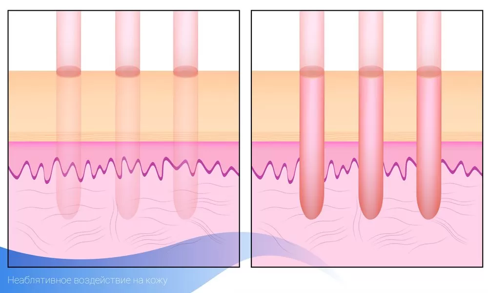 Laserfraktionering med jævn ablation