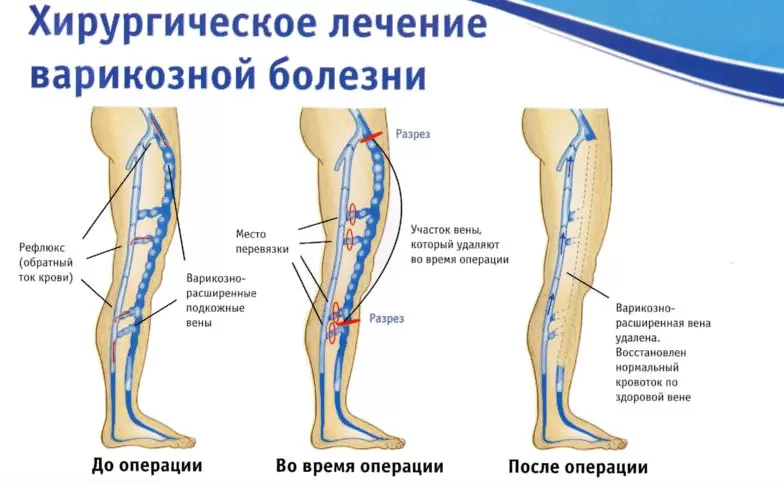 Лечение подкожной вены