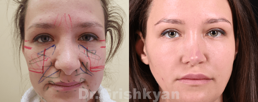 Facial lipofilling, or how to rejuvenate with your own fat!