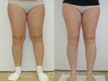Liposuction of the thighs - a proven method of beautiful legs