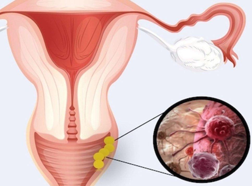Vulvar cancer - zvinokonzera, zviratidzo, kuongororwa uye kurapwa