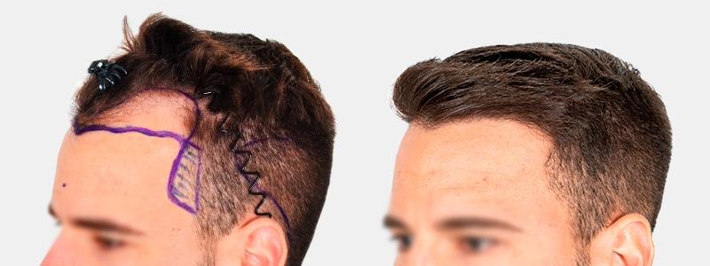 Способы ухода за кожей головы после пересадки волос