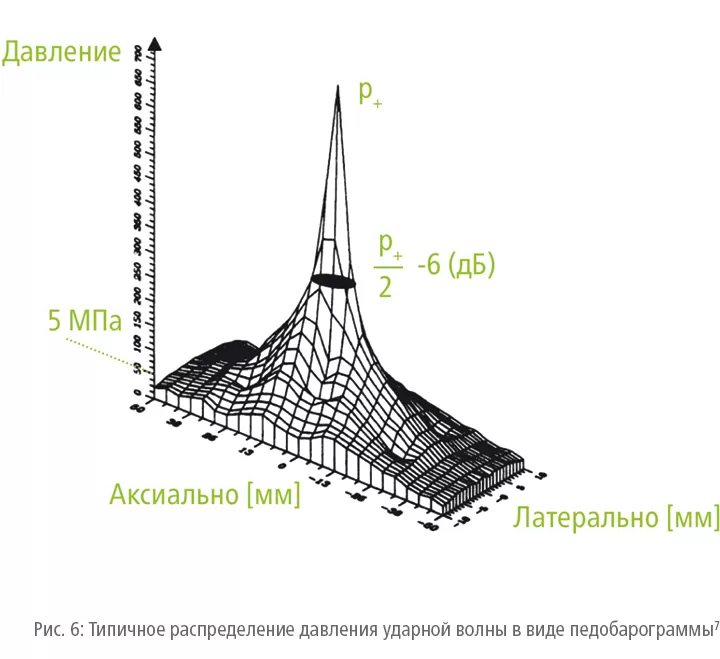 Storz &#8212; ударная волна &#8212; эффекты