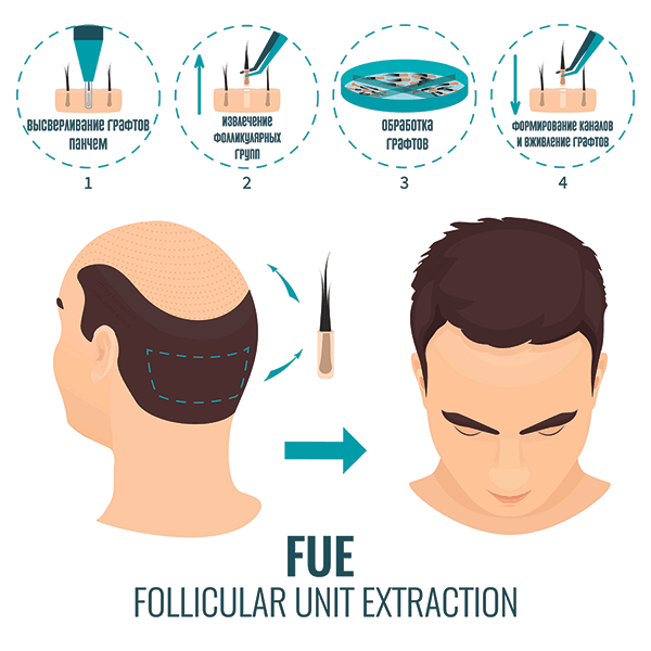 Трансплантация волос STRIP и FUE &#8212; сходства и различия