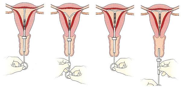 Instalación de dispositivos intrauterinos