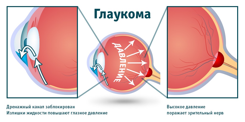 Glaucoma - significatio somnum
