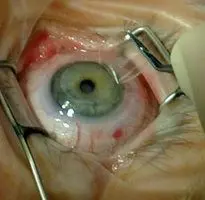 LASIK Augenchirurgie