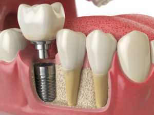 Implanti dentali