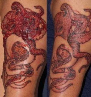 Možete li biti alergični na mastilo za tetoviranje: Alergije i reakcije na mastilo za tetoviranje