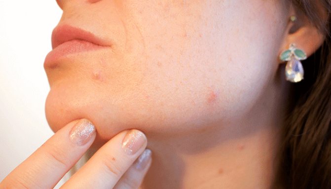 Pimple - loaren garrantzia