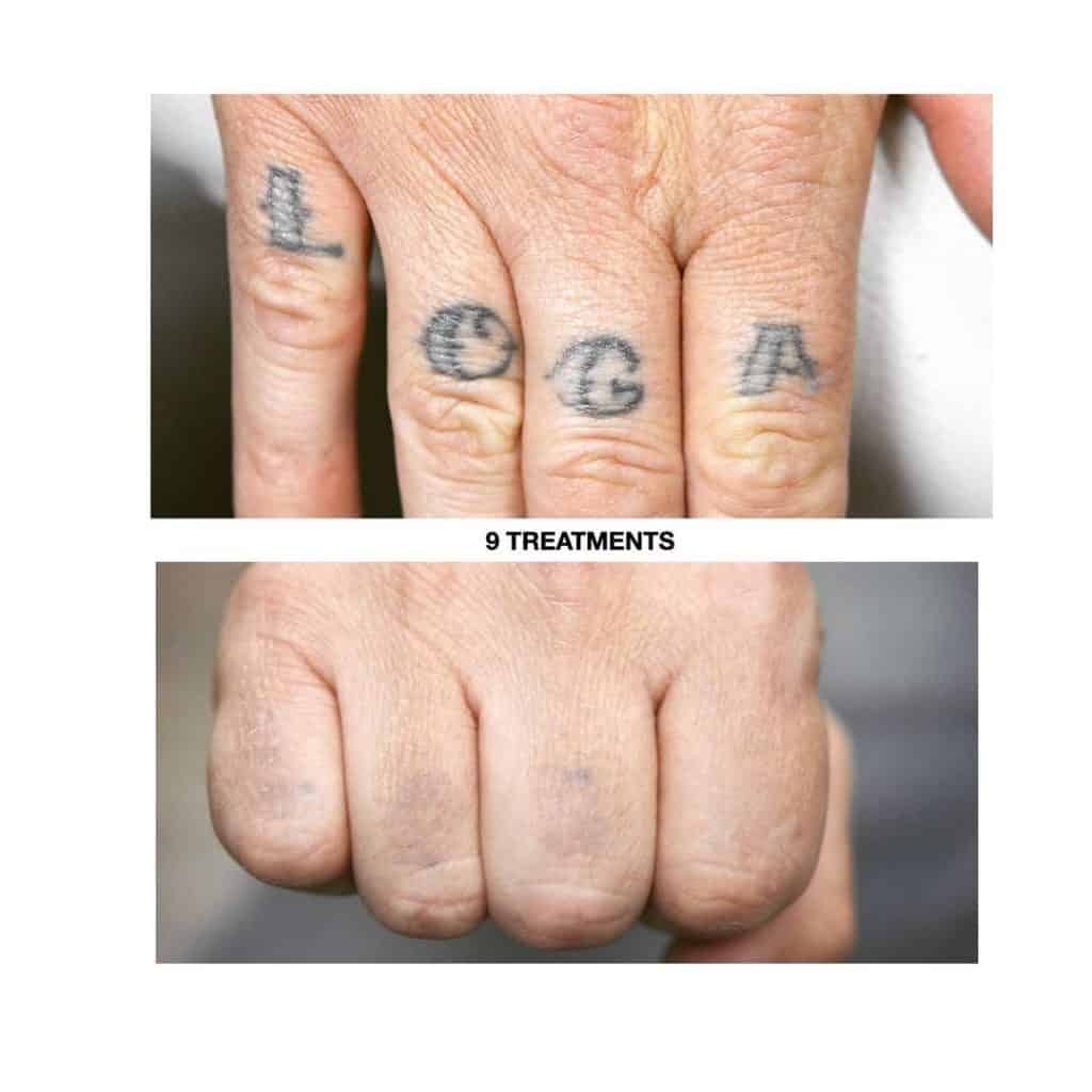 остаются ли шрамы после удаления татуировки
