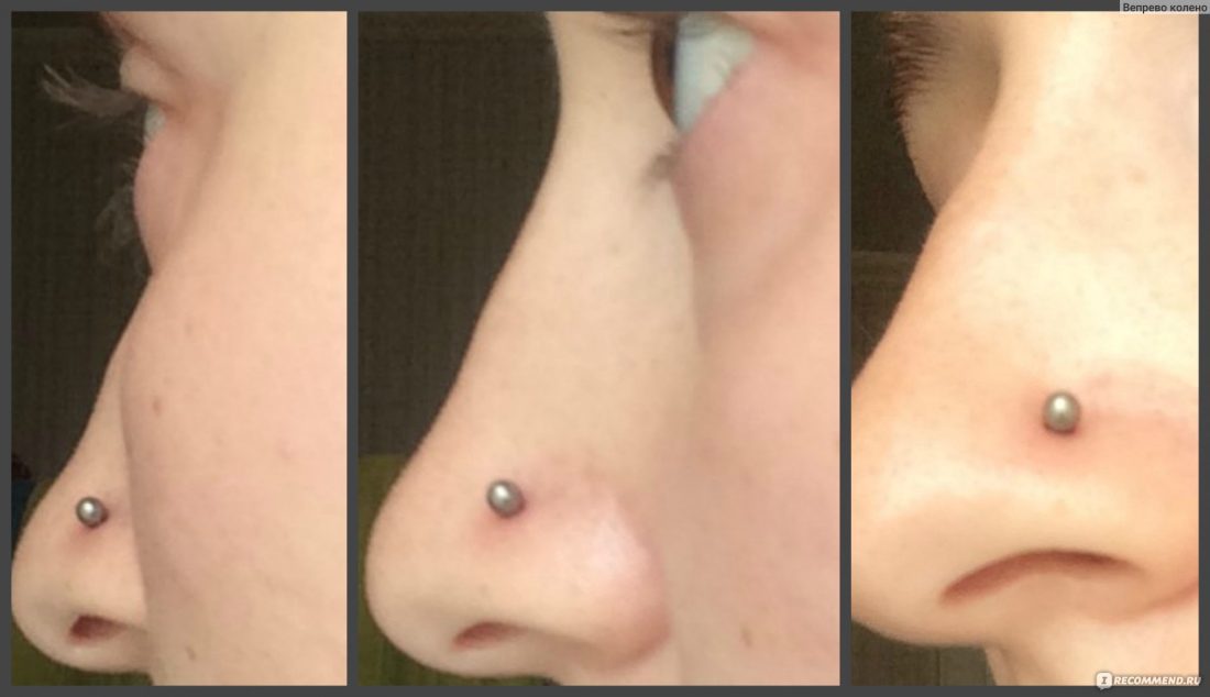 Colisões de piercing no nariz - o que são e como se livrar deles?